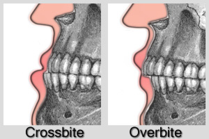 breathing mouth problem Correction HealthGuidance  Overbite