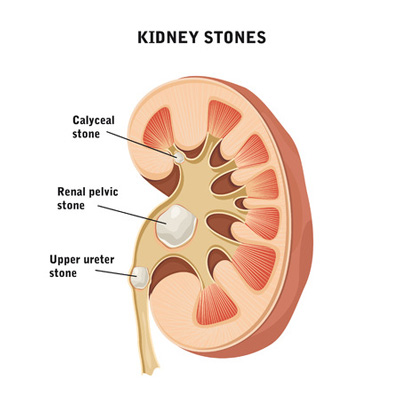 kidney stones renal calculi stone nephrolithiasis nclex illustration urinary review tract shutterstock gov men urine medical clip infection function